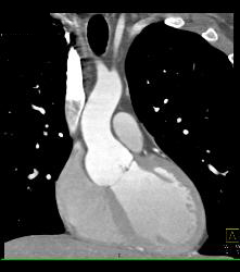 Dilated Root in Marfan Syndrome - CTisus CT Scan