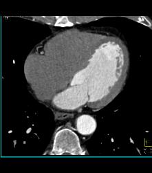 Dilated Root in Marfan Syndrome - CTisus CT Scan