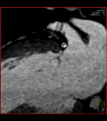 Dilated Root in Marfan Syndrome - CTisus CT Scan