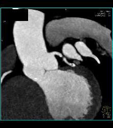 Dilated Root in Marfan Syndrome - CTisus CT Scan