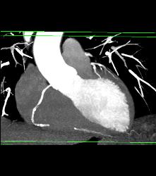 Dilated Root in Marfan Syndrome - CTisus CT Scan