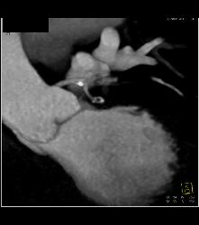 Dilated Root in Marfan Syndrome - CTisus CT Scan