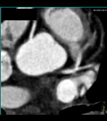 Left Anterior Descending Coronary Artery (LAD) Plaque - Non Calcified Plaque - CTisus CT Scan