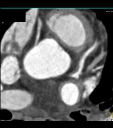 Left Anterior Descending Coronary Artery (LAD) Plaque - Non Calcified Plaque - CTisus CT Scan