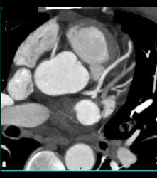 Left Anterior Descending Coronary Artery (LAD) Plaque - Non Calcified Plaque - CTisus CT Scan