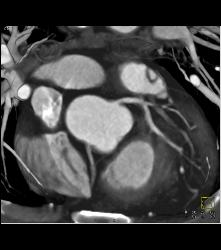 Left Anterior Descending Coronary Artery (LAD) Plaque - Non Calcified Plaque - CTisus CT Scan