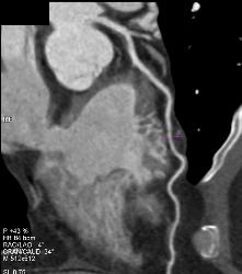 Left Anterior Descending Coronary Artery (LAD) Plaque - Non Calcified Plaque - CTisus CT Scan