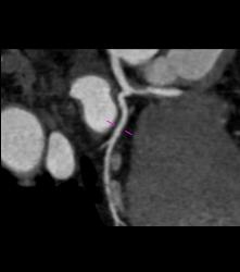 Left Anterior Descending Coronary Artery (LAD) Plaque - Non Calcified Plaque - CTisus CT Scan