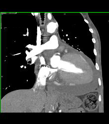 Pericardial Effusion - CTisus CT Scan