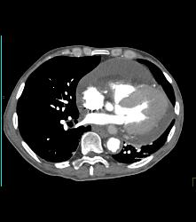 Pericardial Effusion - CTisus CT Scan