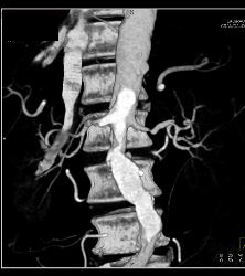 Ulcerations in Abdominal Aorta With Stenosis - CTisus CT Scan