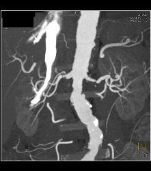 Ulcerations in Abdominal Aorta With Stenosis - CTisus CT Scan