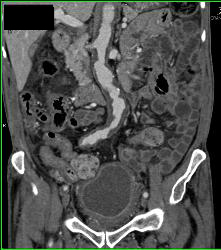 Ulcerations in Abdominal Aorta With Stenosis - CTisus CT Scan