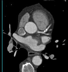 Plaque in Left Anterior Descending Coronary Artery (LAD) and Right Coronary Artery (RCA) - CTisus CT Scan