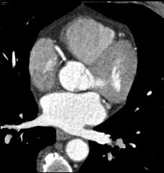 Plaque in Left Anterior Descending Coronary Artery (LAD) and Right Coronary Artery (RCA) - CTisus CT Scan