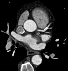 Plaque in Left Anterior Descending Coronary Artery (LAD) and Right Coronary Artery (RCA) - CTisus CT Scan