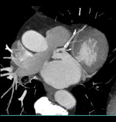 Plaque in Left Anterior Descending Coronary Artery (LAD) and Right Coronary Artery (RCA) - CTisus CT Scan