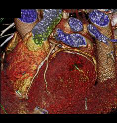 Plaque in Left Anterior Descending Coronary Artery (LAD) and Right Coronary Artery (RCA) - CTisus CT Scan