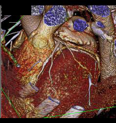 Plaque in Left Anterior Descending Coronary Artery (LAD) and Right Coronary Artery (RCA) - CTisus CT Scan