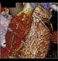 Plaque in Left Anterior Descending Coronary Artery (LAD) and Right Coronary Artery (RCA) - CTisus CT Scan