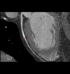 Plaque in Left Anterior Descending Coronary Artery (LAD) and Right Coronary Artery (RCA) - CTisus CT Scan