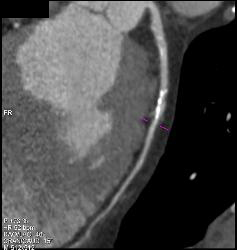 Plaque in Left Anterior Descending Coronary Artery (LAD) and Right Coronary Artery (RCA) - CTisus CT Scan