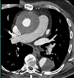 Repair of Ascending Aorta Plus Dissection of the Descending Aorta - CTisus CT Scan