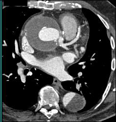 Repair of Ascending Aorta Plus Dissection of the Descending Aorta - CTisus CT Scan