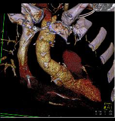 Repair of Ascending Aorta Plus Dissection of the Descending Aorta - CTisus CT Scan