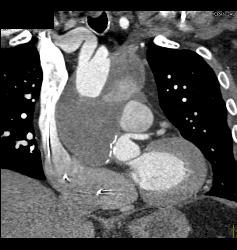 Repair of Ascending Aorta Plus Dissection of the Descending Aorta - CTisus CT Scan