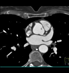 Fibroma on the Aortic Valve - CTisus CT Scan