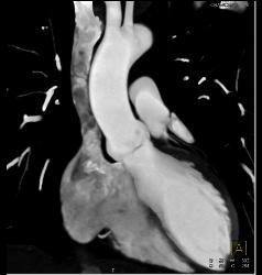 Fibroma on the Aortic Valve - CTisus CT Scan