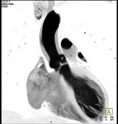 Fibroma on the Aortic Valve - CTisus CT Scan