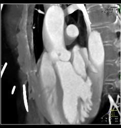 Fibroma on the Aortic Valve - CTisus CT Scan