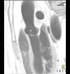 Fibroma on the Aortic Valve - CTisus CT Scan