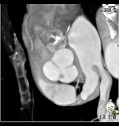 Fibroma on the Aortic Valve - CTisus CT Scan