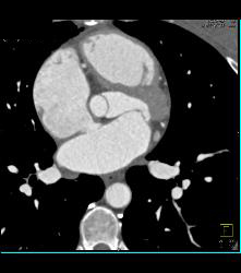 Normal Pulmonary Valve - CTisus CT Scan