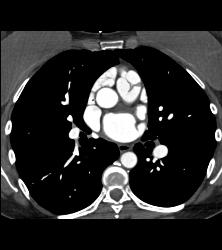 Normal Pulmonary Valve - CTisus CT Scan