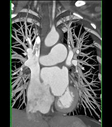 Normal Pulmonary Vasculature - CTisus CT Scan