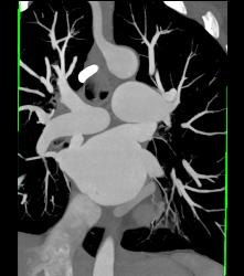 Normal Pulmonary Vasculature - CTisus CT Scan