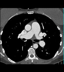 Dilated ??? Pulmonary Trunk - CTisus CT Scan