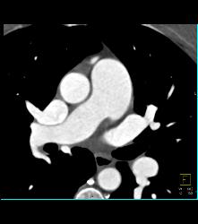 Dilated ??? Pulmonary Trunk - CTisus CT Scan