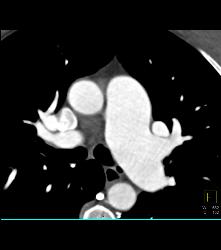 Dilated ??? Pulmonary Trunk - CTisus CT Scan