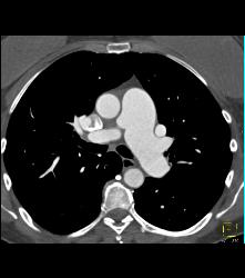 Dilated ??? Pulmonary Trunk - CTisus CT Scan