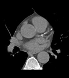 Left Anterior Descending Coronary Artery (LAD) Disease With Greater Than 50% Stenosis - CTisus CT Scan