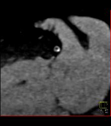 Left Anterior Descending Coronary Artery (LAD) Disease With Greater Than 50% Stenosis - CTisus CT Scan