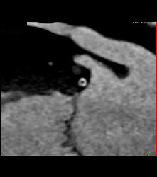 Left Anterior Descending Coronary Artery (LAD) Disease With Greater Than 50% Stenosis - CTisus CT Scan