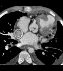 Patent Shunt to Inferior Vena Cava (IVC) - CTisus CT Scan