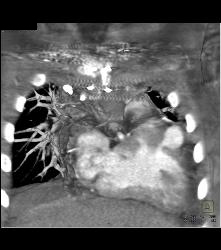 Transposition of the Great Vessel - CTisus CT Scan