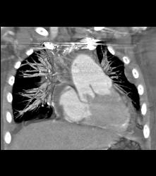 Transposition of the Great Vessel - CTisus CT Scan